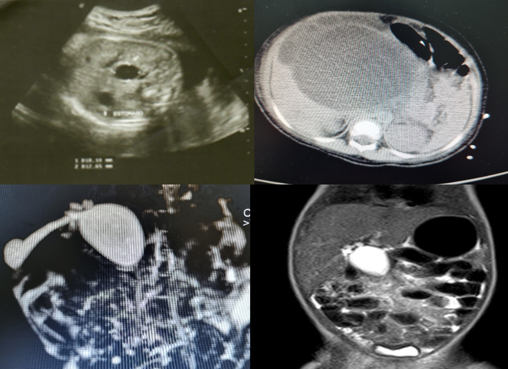 Choledochal cyst with prenatal diagnosis
